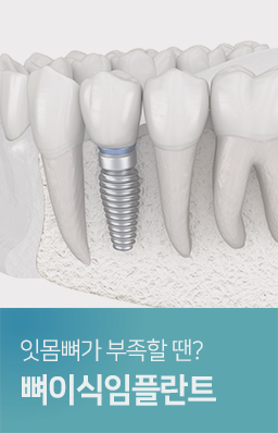 잇몸뼈가-부족할-땐-뼈이식-임플란트