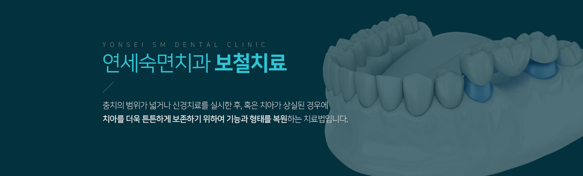 연세숙면치과-보철치료-충치의-범위가-넓거나-신경치료를-실시한-후-혹은-치아가-상실된-경우에-치아를-더욱-튼튼하게-보존하기-위하여-기능과-형태를-복원하는-치료법입니다