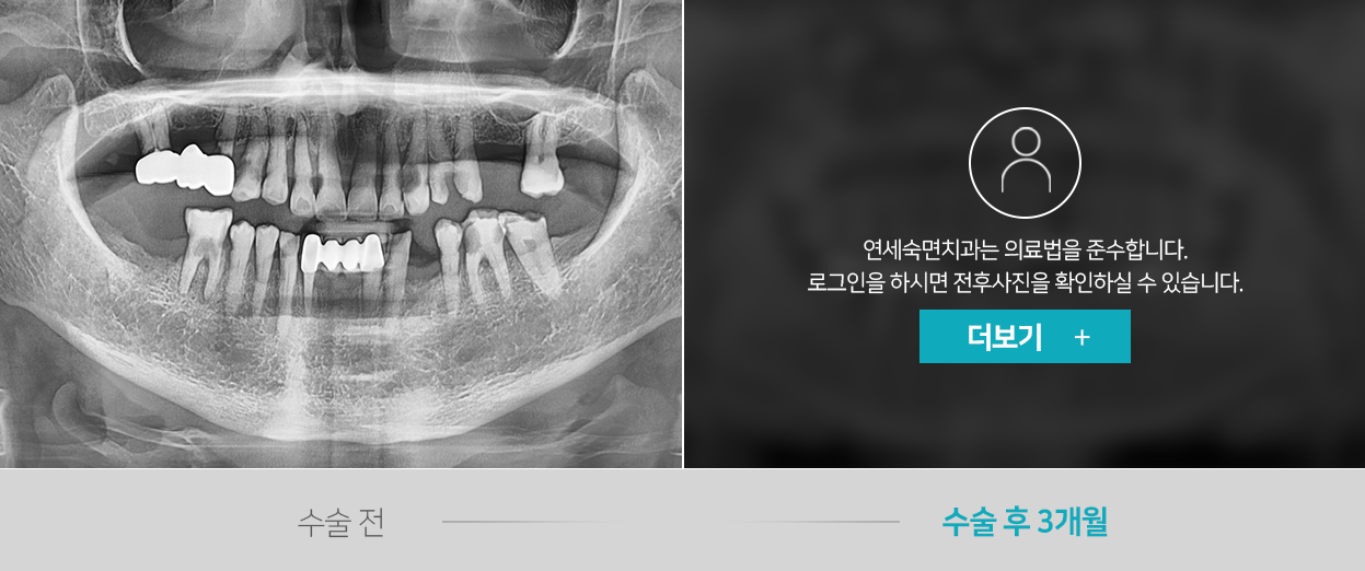 임플란트-전후사진1