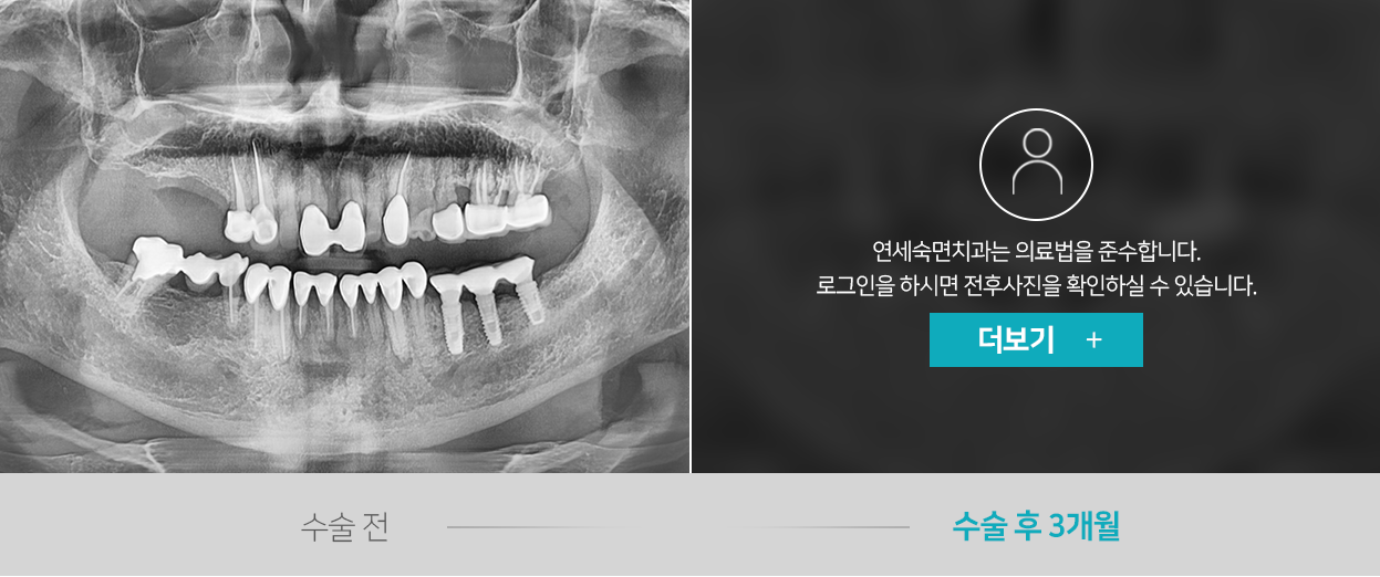 임플란트-전후사진2