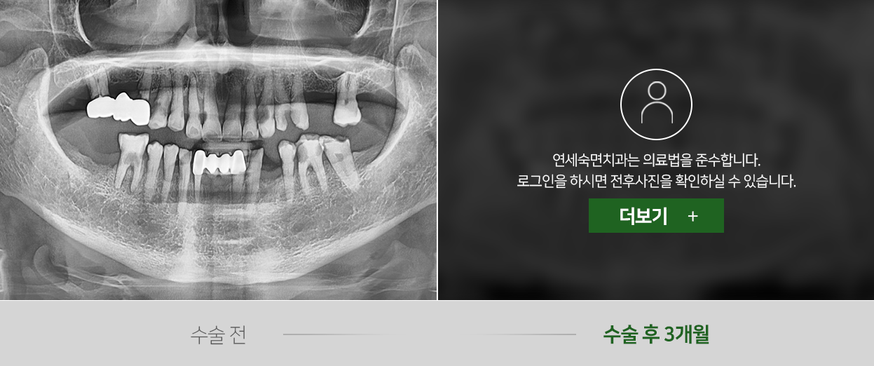 임플란트-전후사진1