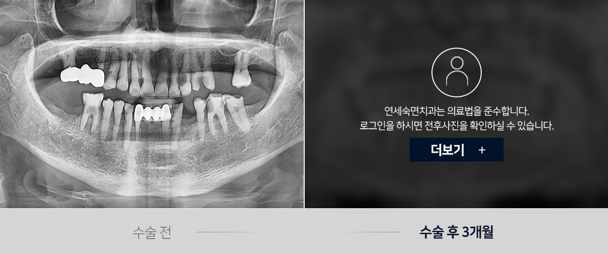 임플란트-전후사진1