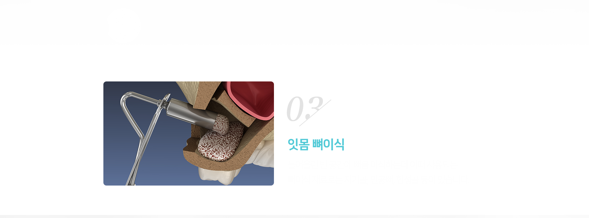 3단계-잇몸-뼈이식-시술-진행-들어-올린-빈-공간에-뼈를-이식하는데-이때-사용되는-뼈이식-재료로는-자가골-인공뼈-합성골-등이-있습니다