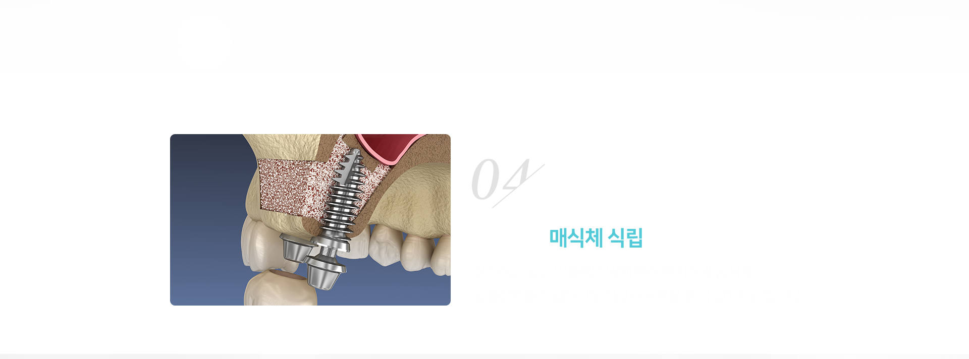 4단계-임플란트-매식체-식립-잔존하고-있는-잇몸뼈의-양에-따라-뼈이식과-동시에-임플란트를-식립하기도-하고-6~9개월--후-식립하기도-합니다