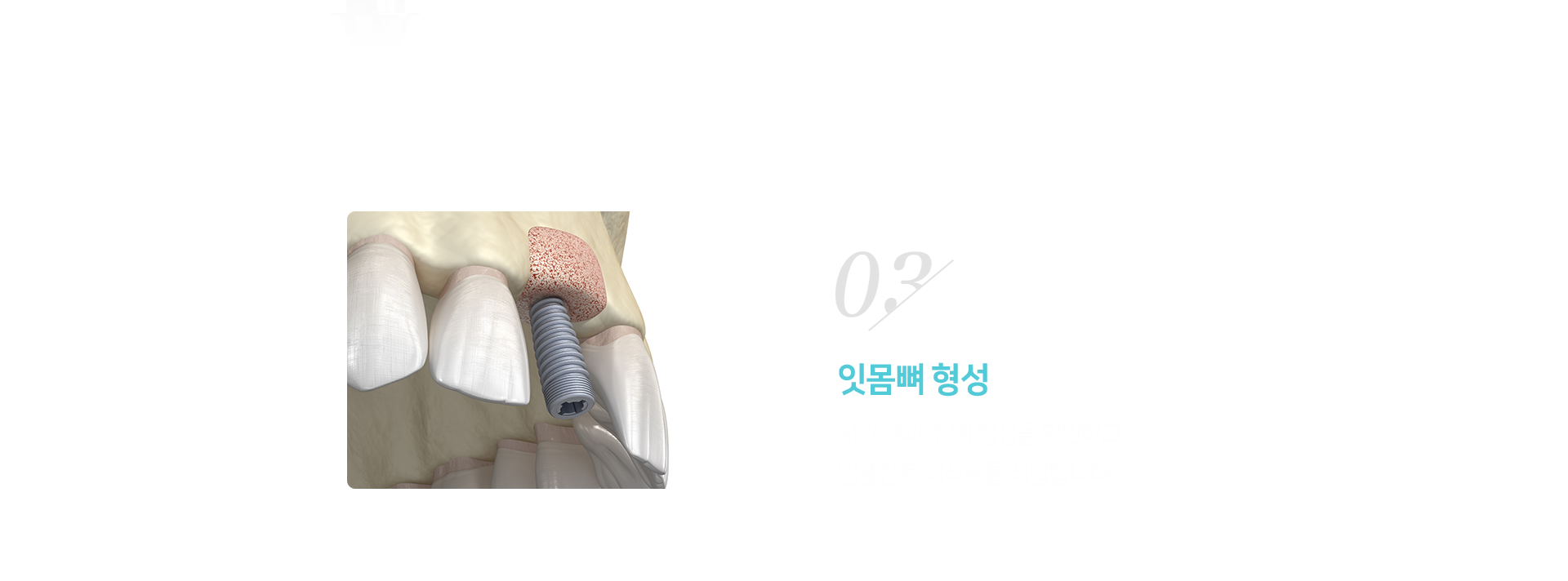 3단계-잇몸뼈-형성-확인-시간-경과-후-뼈-형성을-확인하고-임플란트-매식체를-식립합니다