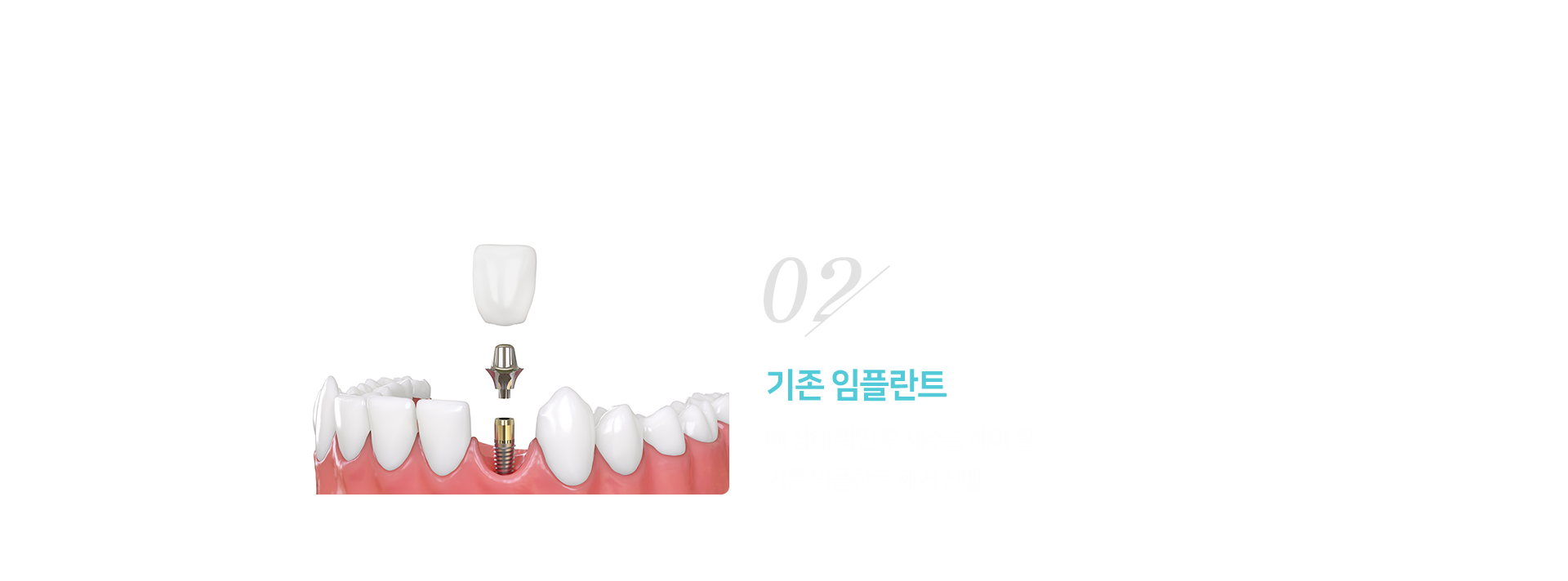 2단계-기존-임플란트-제거-뼈-상태-확인-후-재수술해야-할-기존-임플란트-제거-진행