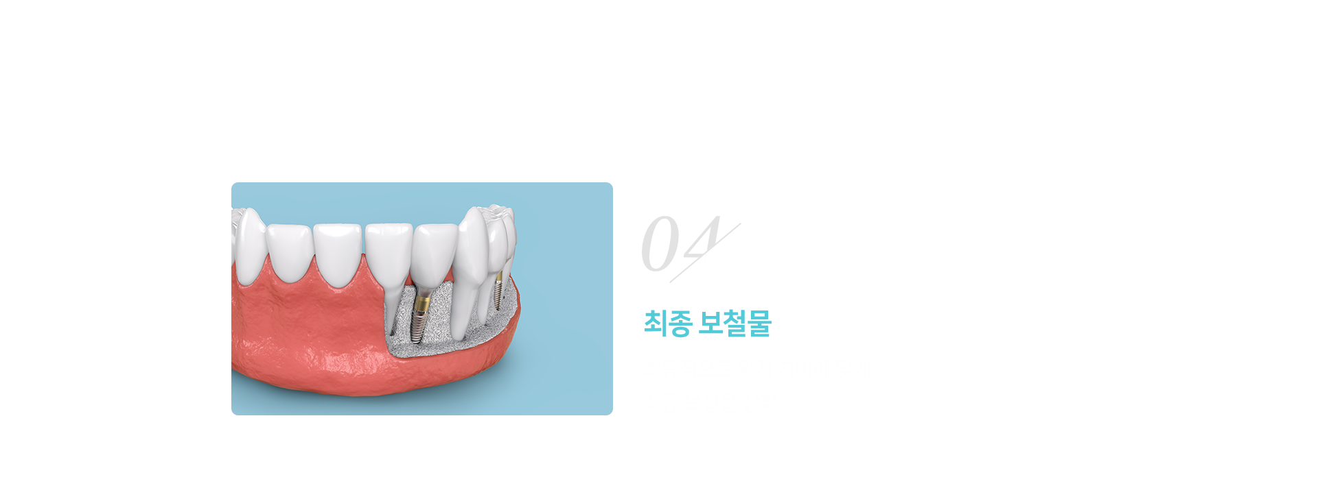 4단계-최종-보철물-장착-최종적으로-환자-치아에-맞게-최종-보철물-장착