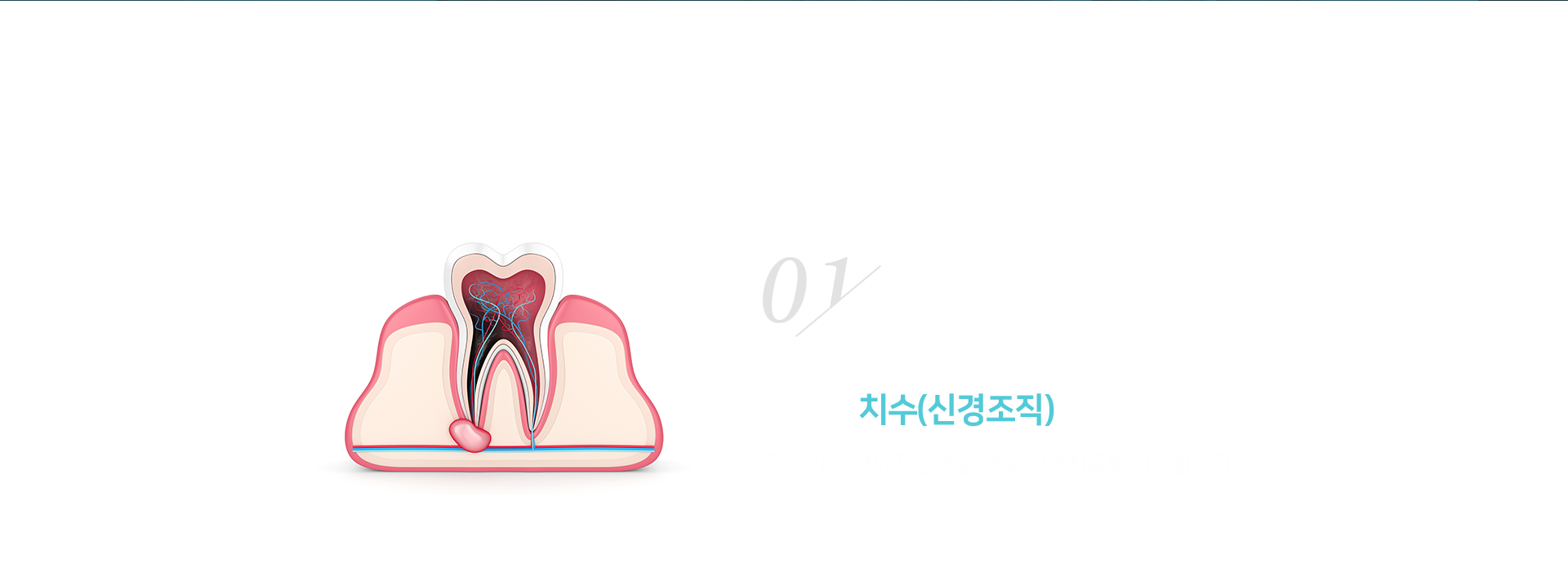 1단계-감염된-치수-신경조직-충치가-신경까지-진행된-경우-신경치료를-시행합니다