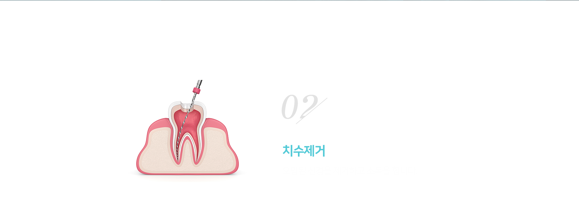 2단계-치수-제거-및-소독-오염된-신경을-제거하고-소독을-합니다